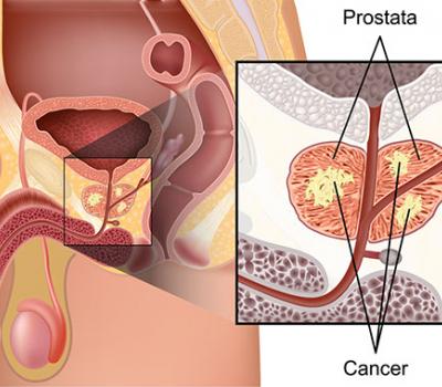 Cancer de Próstata